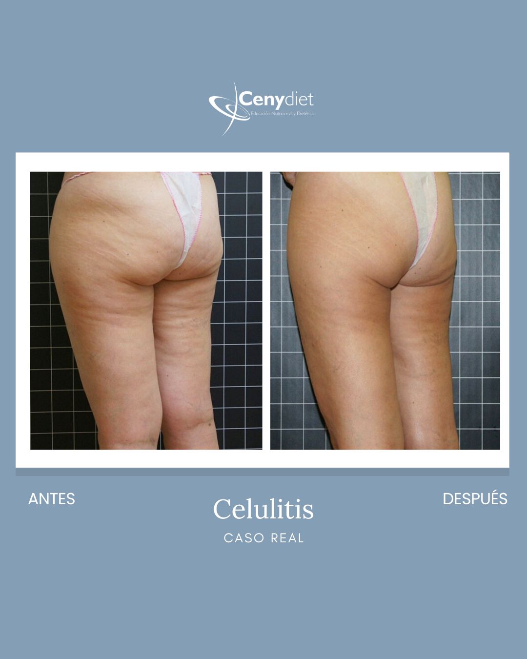 Cenydiet tratamiento celulitis piernas gluteos 2 en Jaén